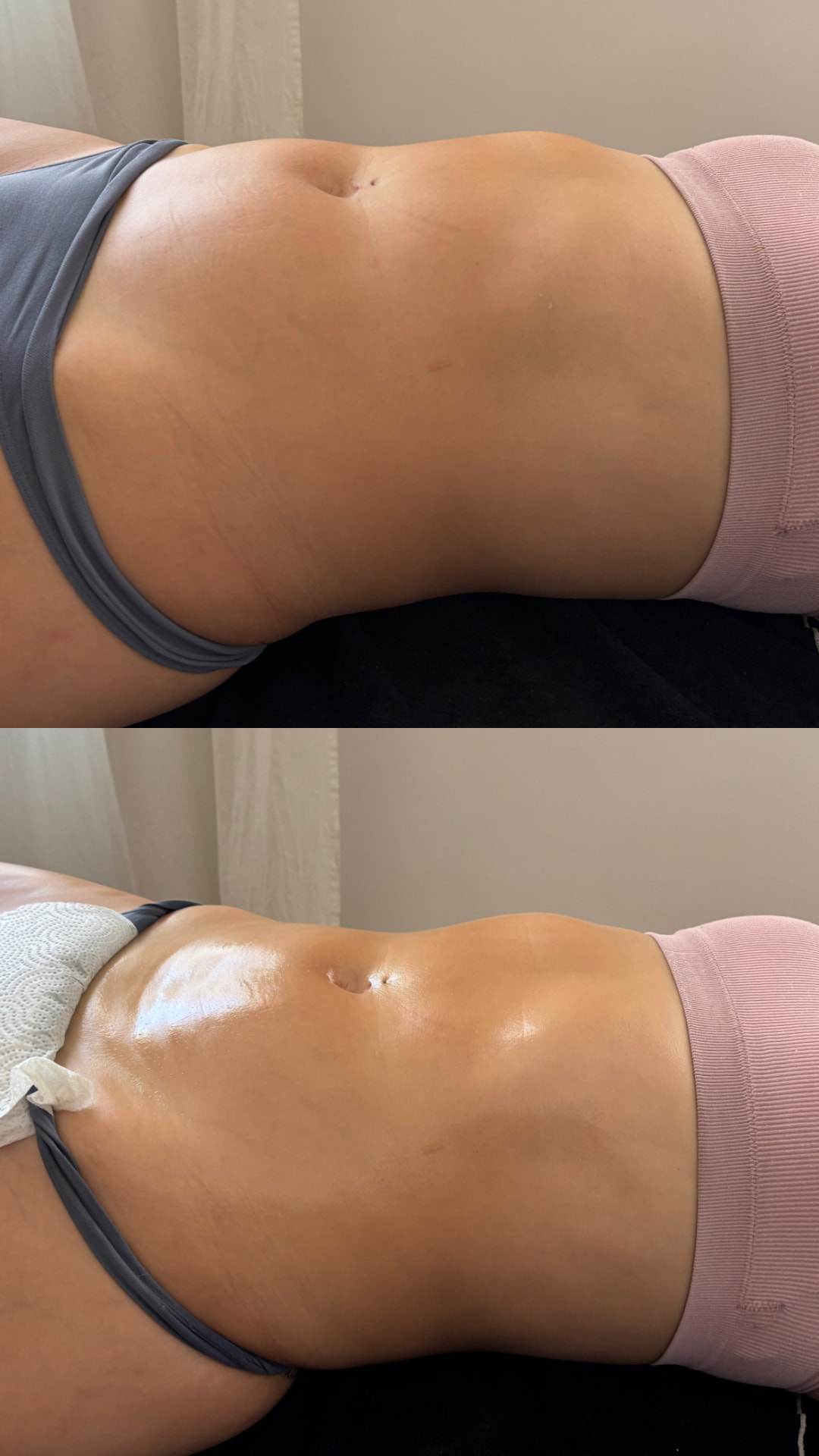 Antes y después de Maderoterapia + radiofrecuencia a domicilio