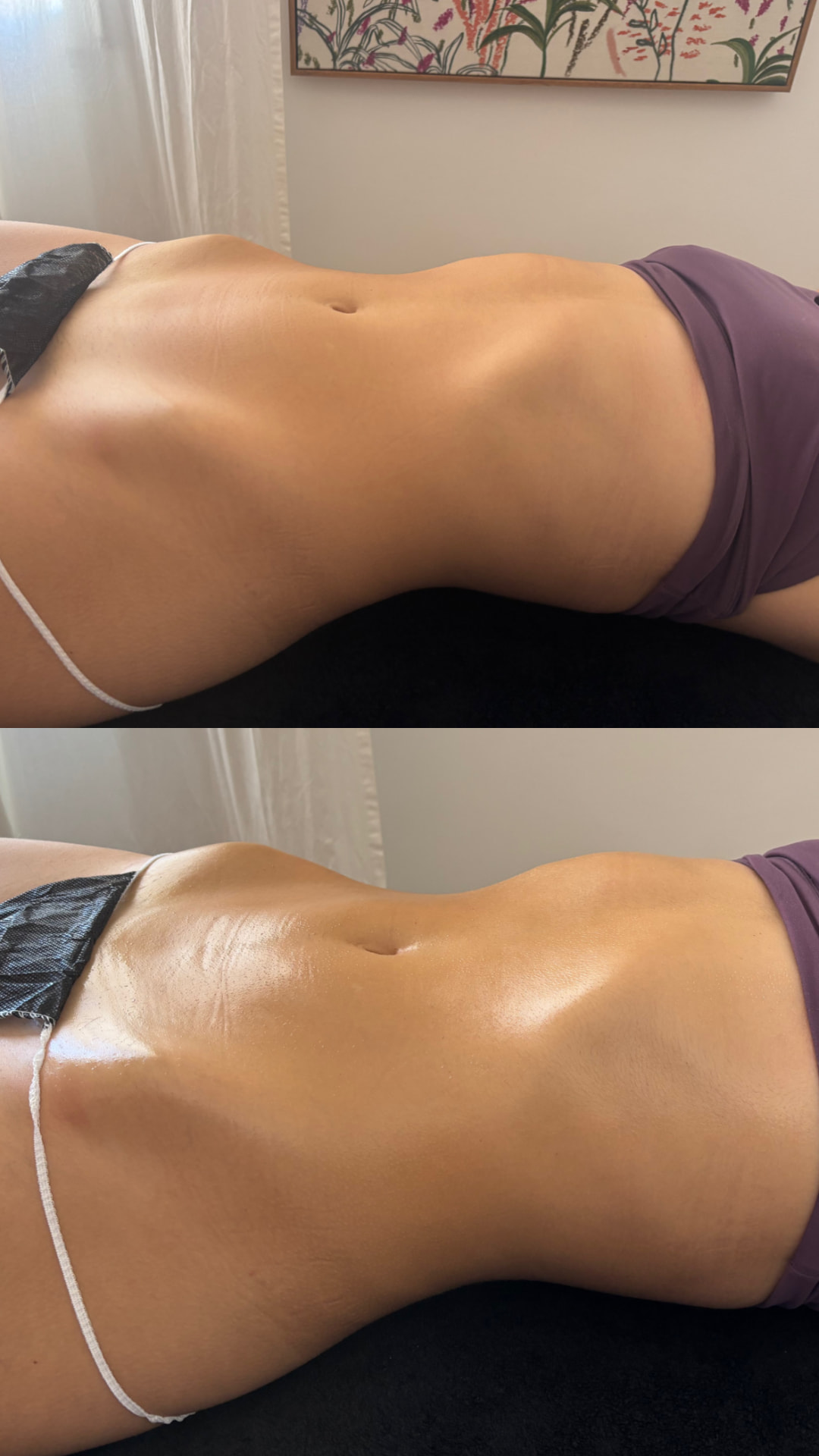 Antes y después de Maderoterapia corporal a domicilio
