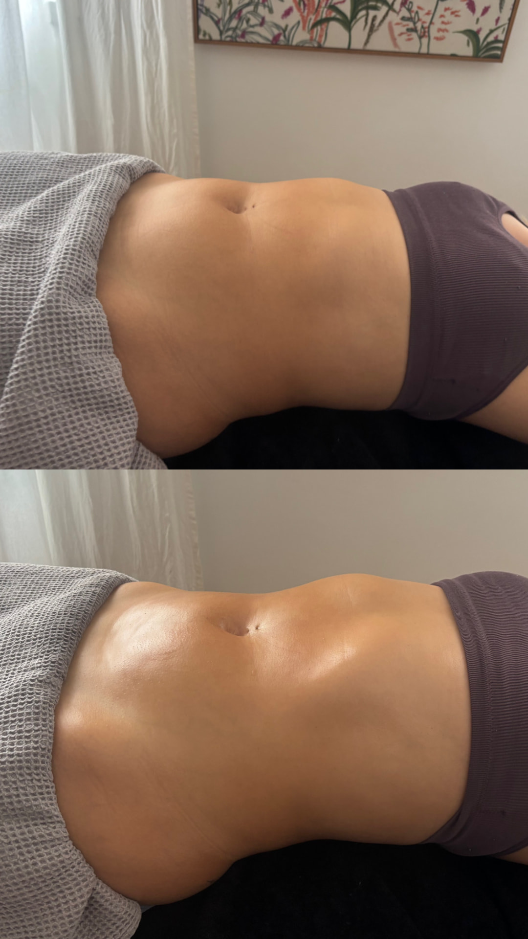 Antes y después de Maderoterapia + drenaje a domicilio