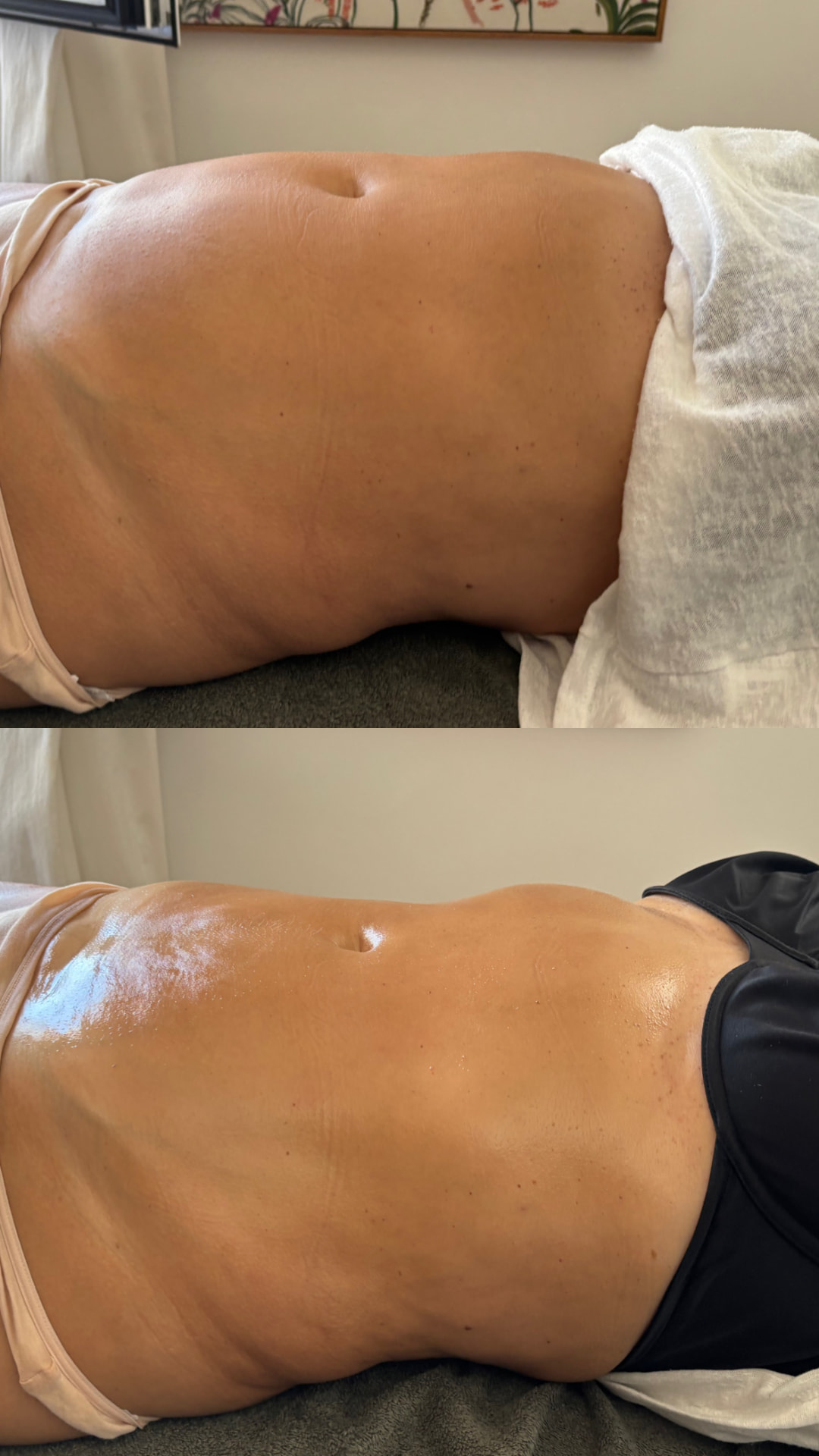 Antes y después de Drenaje linfático a domicilio